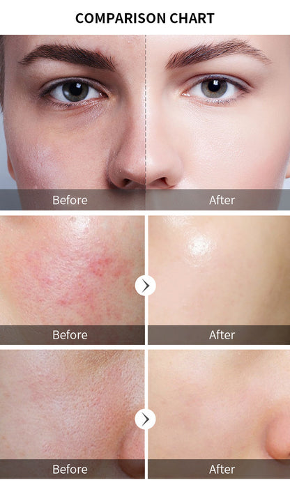 Tartaric Acid Stock Solution Cleansing Pores Softening Cutin